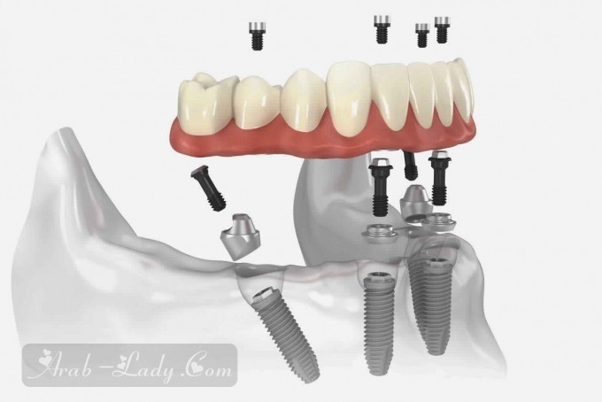 ملف متكامل عن زراعة الأسنان وأحدث الابتكارات الطبية