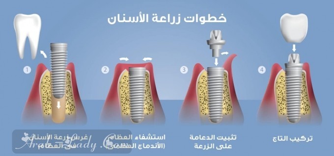 ملف متكامل عن زراعة الأسنان وأحدث الابتكارات الطبية