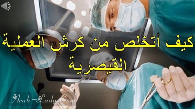 أفضل طرق علاج ترهلات الولادة القيصرية والطبيعية