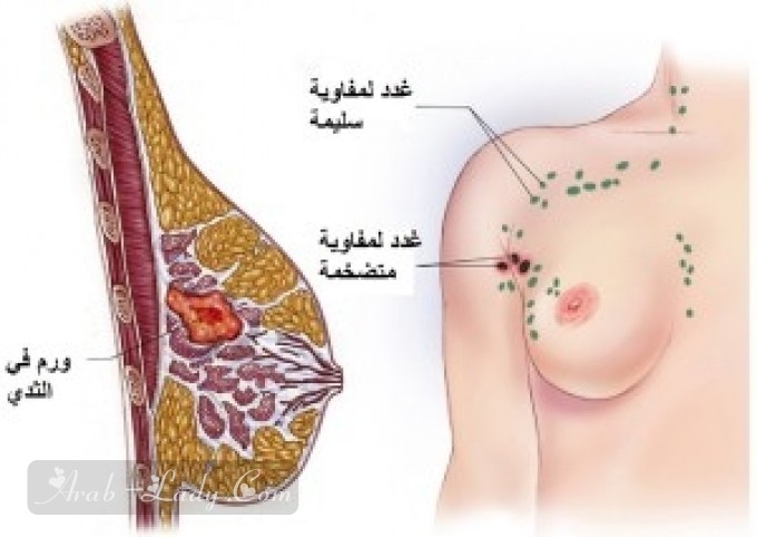 كل ما يجب معرفته عن أورام وسرطان الثدي