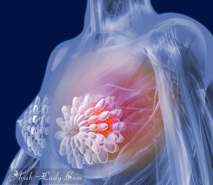 كل ما تريدين معرفته عن سرطان الثدي من الأسباب والأعراض إلى العلاج
