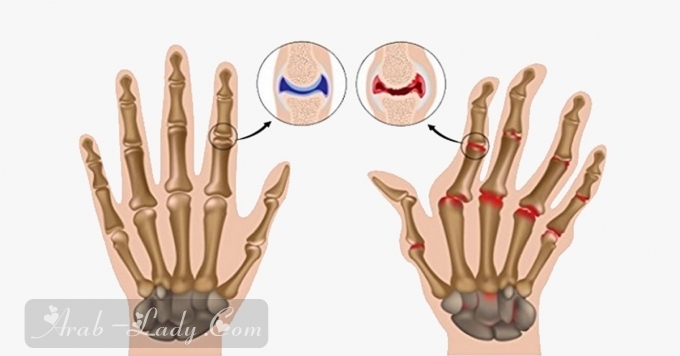 الطرق الصحيحة لمواجهة آثار التهاب المفاصل (الروماتويد) على اليدين