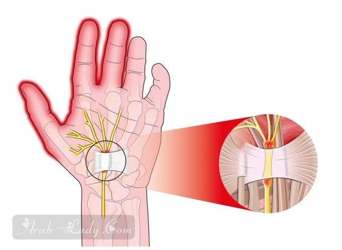 كل ما يجب أن تعرفيه عن متلازمة النفق الرسغي - CTS