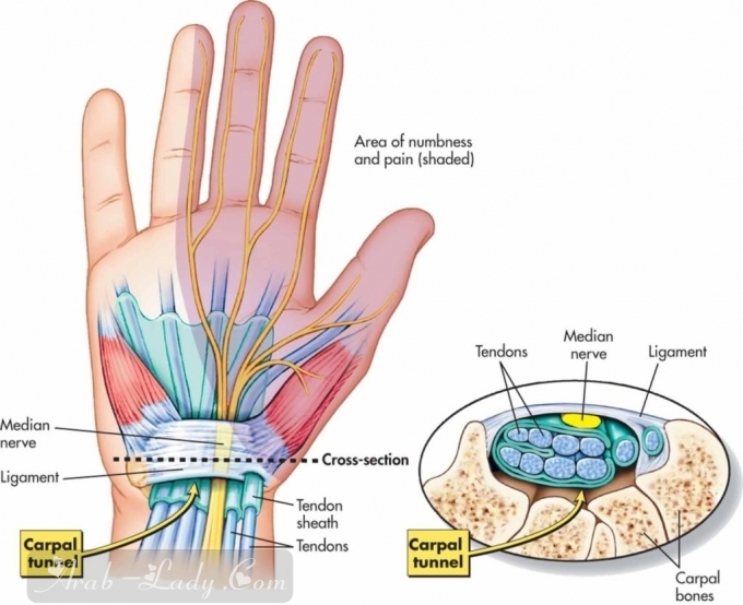كل ما يجب أن تعرفيه عن متلازمة النفق الرسغي - CTS