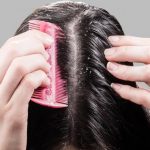 قشرة الشعر بـ 3 طرق طبيعية تتخلصين منها للأبد