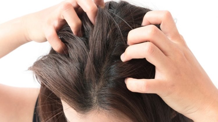 قشرة الشعر بـ 3 طرق طبيعية تتخلصين منها للأبد