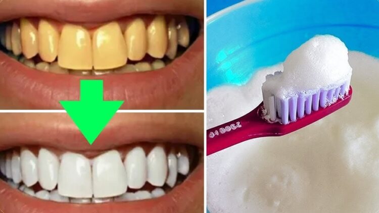 تبييض الأسنان : 6 وصفات طبيعية للحصول على ابتسامة النجمات