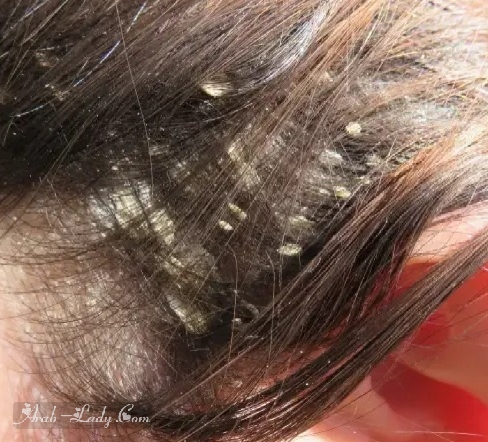 نوع قشرة الشعر الدهنية