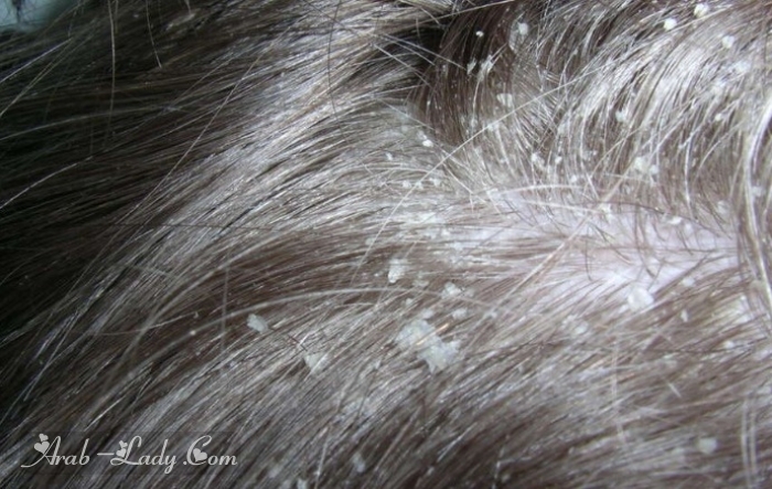  قشرة الشعر الصدفية